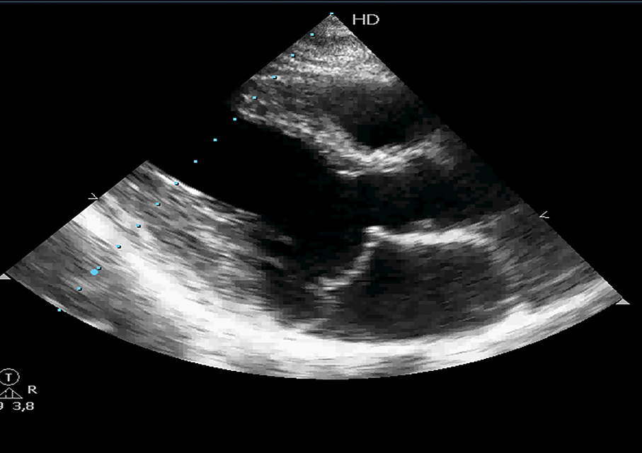 Mitral valve epidemiology and causes